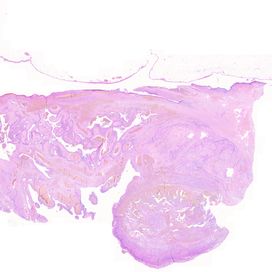 Ovarian neoplasm