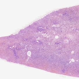 02_carcinoma_of_liver_secondary_40x_065_035x_adapter_acA2040-55uc_14m00s