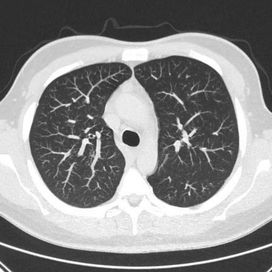 CT thorax with lung