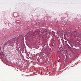 Epitheliale Hautläsionen – Internationale Akademie für Pathologie