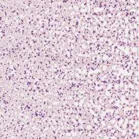 CLL w/ Prolymphocytes