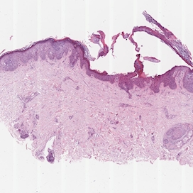 Epitheliale Hautläsionen – Internationale Akademie für Pathologie